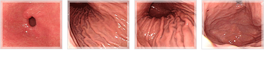 정상 위의 내시경 사진