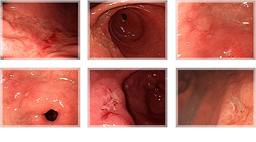 조기위암 내시경 사진