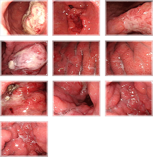 진행성 위암 내시경 사진
