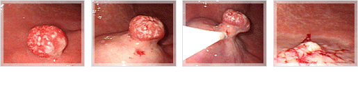 위 용종 절제술