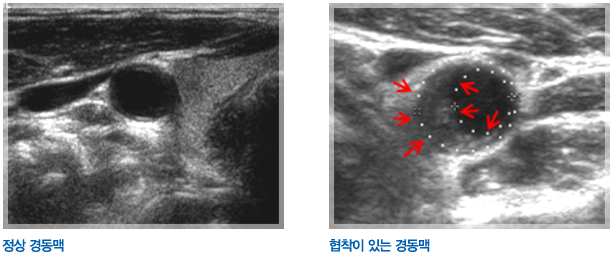 정상경동맥과 협착이 있는 경동맥 비교사진